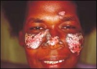 Dépigmentation de la peau : au-delà du complexe, des raisons…complexes