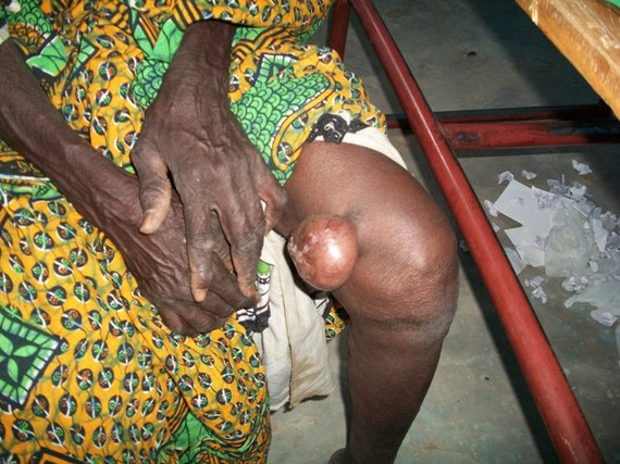 Avant chirurgie Avant chirurgie