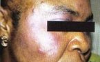 Dépigmentation de la peau : au-delà du complexe, des raisons…complexes